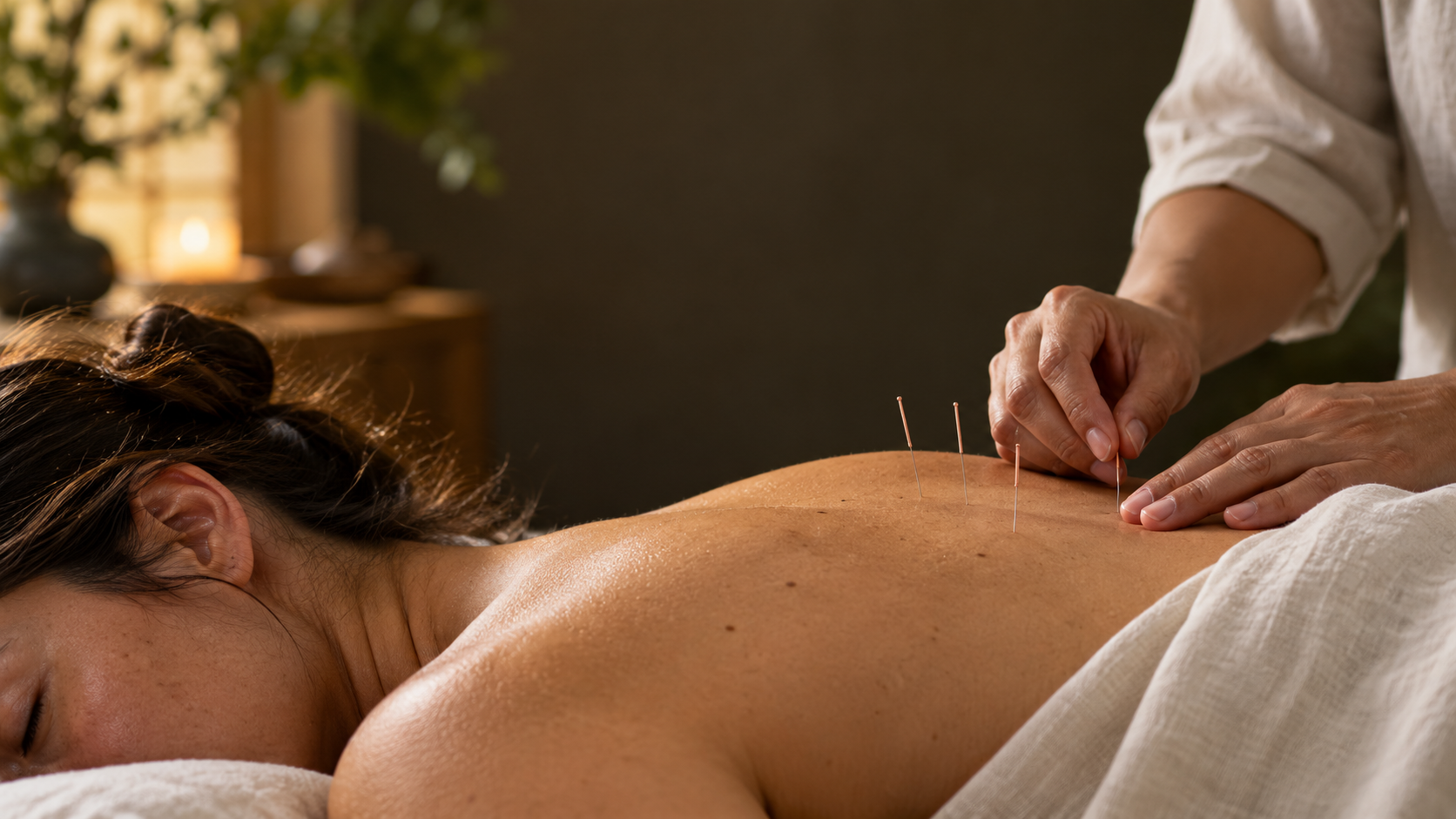 A practitioner placing visible acupuncture needles in a recipient’s back